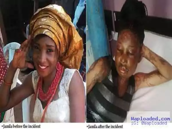 Young girl dating a married man gets bathed with acid in Abuja (Photos)